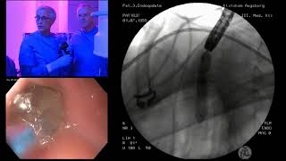 Esophageal stenosis after caustic burn [upl. by Chaworth872]