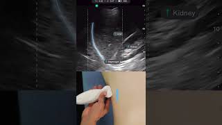 Lung Zone Right 4 with Handheld Ultrasound Exo Iris® [upl. by Aoket]