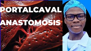 Portalcaval anastomosis Indication liver physiology and complications of the procedure [upl. by Nava]