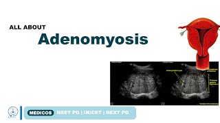 ADENOMYOSIS TYPES SYMPTOMS  DIAGNOSIS TREATMENT  NEETPG  INICET  MEDICOS [upl. by Naget196]