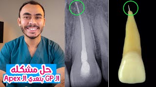 Gutta Percha Extrusion in Endodontic Obturation [upl. by Llertnad]