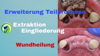 Erweiterung einer Unterkiefer Teilprothese Abdrucknahme Zahnentfernung Eingliederung Wundheilung [upl. by Oivlis]