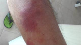 Cellulitis on a patients shin before and 4 days after treatment [upl. by Kitty]