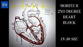 Mobitz II 2nd Degree Heart Block Animation and ECG Shorts [upl. by Ennaeilsel]