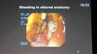 32 Device assisted enteroscopy utility in small bowel bleeding Prof Lars Aabakken [upl. by Milburt]