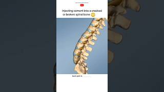 Vertebroplasty procedure short [upl. by Melliw]