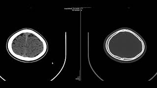 case 11b  CT of the case 11a [upl. by Ennailuj]