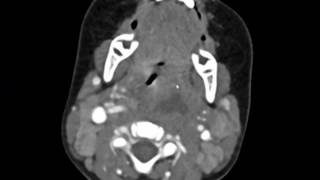 Retropharyngeal Abscess Imaging Studies short version [upl. by Otsugua]