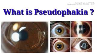 What is pseudophakia  sign  Intraocular lens  sharp vision [upl. by Lemmy]