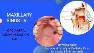 Maxillary sinus  Oroantral Communication [upl. by Warden497]