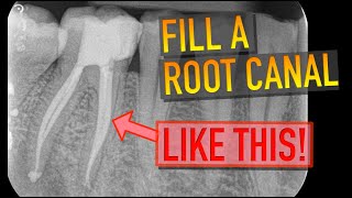 HOW TO OBTURATE A TOOTH  LIVE RCT  4K Resolution [upl. by Ieluuk]