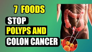 7 Superfoods to Get Rid of Colon Polyps and Prevent Bowel Cancer [upl. by Nyret246]