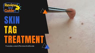 Skin Tags Acrochordons Causes Treatment and Removal [upl. by Ellon325]