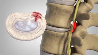 Herniated Disc  Patient Education [upl. by Artemus]