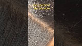 Lice treatment nits haircare nitsremoval headlice headliceremoval peenu  eeru nitslicecare [upl. by Paterson]