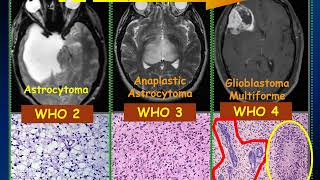 MedPix Video  Diffuse Gliomas [upl. by Dirgis205]