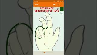 Position of Benediction of Hand UPPER LIMB ANATOMY lumbricalsinjury [upl. by Publia999]