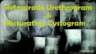 RGU MCU Retrograde Urethrogram and Micturating Cystogram Case Interpretation [upl. by Cchaddie467]