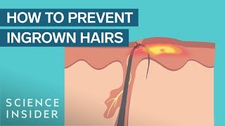 What Are Ingrown Hairs — And How To Treat Them [upl. by Nadya119]