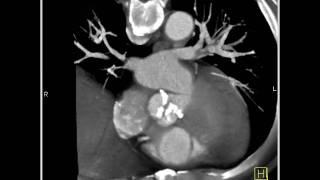 4D Imaging of the Aortic Valve Aortic valve 3 of 3 [upl. by Nawad]