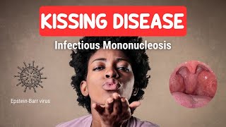 KISSING DISEASE or Infectious Mononucleosis [upl. by Ader]