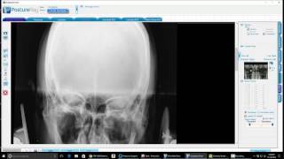 Orthospinology Nasium Analysis Dr Bo Rochester [upl. by Nnailuj]