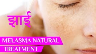 झाइयां  Melasma Treatment  pigmentation  face pigmentation  pigmentation on face  Beauty Tips [upl. by Verda10]