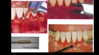 Gingivectomy amp Gingivoplasty [upl. by Siloa]