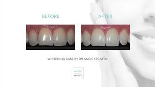 White Dental Beauty Before and After Video [upl. by Dinse850]