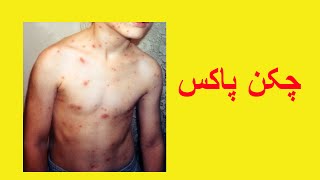 Chicken Pox Information in Urdu [upl. by Risley962]