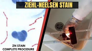 Ziehl Neelsen StainAcid Fast StainZN StainZiehl Neelsen Stain ProcedureAdnanMLT [upl. by Sybyl]