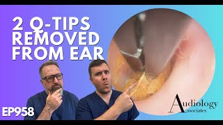 2 QTIPS REMOVED FROM EAR  EP958 [upl. by Yrok]