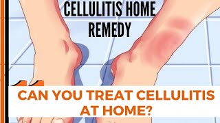 Can You Treat Cellulitis at Home  cellulitis home remedy [upl. by Laryssa]