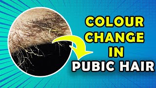 Get rid of colour change in pubic hair and under arm hair Trichomycosis [upl. by Kubis206]