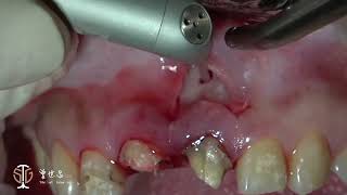 Restorative Crown Lengthening in Esthetic Zone amp Apicoectomy with Giuded Tissue Regeneration IV [upl. by Lednek93]