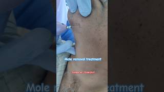 Mole removal moleremoval skintags skincare aesthetic youtubeshorts skintreatment face jaipur [upl. by Cynthla]