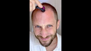 How I Use DermaRoller for Hair Growth and To Solve my Baldness and Hair Loss Tutorial 4k [upl. by Cheri666]