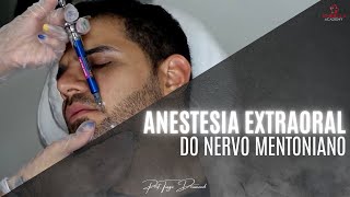 Anestesia extraoral do nervo mentoniano [upl. by Bernetta]