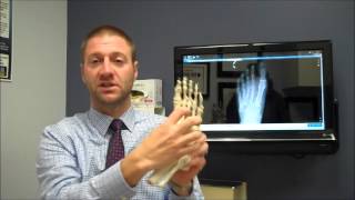 Lisfranc Injuries [upl. by Harman]