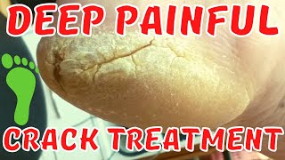 Deep painful crack treatment Thick skin removal [upl. by Aehsrop]