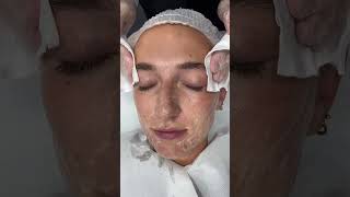 Benefits of Mandelic Acid Skin Peels  Dr Medispa [upl. by Toolis]