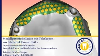 Modellgussmodellation mit Teleskopen aus SilaPart amp Exocad Teil 1 [upl. by Oswell124]