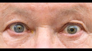 Anisocoria  Symptoms and Causes  Diagnosis  Treatment  Prevention [upl. by Annaj]