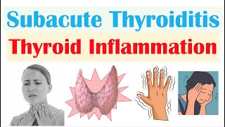 Subacute Thyroiditis Thyroid Inflammation De Quervain’s  Causes Symptoms Diagnosis Treatment [upl. by Myrt]