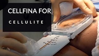 SEE HOW CELLFINA  SCULPTRA ELIMINIATE CELLULITE FOREVER ON THE LEGS AND BUTTOCK  DR JASON EMER [upl. by Asenad426]