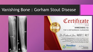 Gorhams Stout Disease  Vanishing Bone Disease Lymph Vessels into bone [upl. by Nikita591]