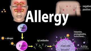 Allergy  Mechanism Symptoms Risk factors Diagnosis Treatment and Prevention Animation [upl. by Ehctav]