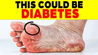 ALERT 18 SIGNS of DIABETES on THE SKIN that FEW PEOPLE KNOW  110 [upl. by Vudimir935]