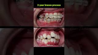 Braces evolution  2 years braces orthodontist dentist [upl. by Kester443]