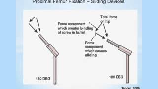 Biomechanics of Hip Osteotomies [upl. by Eiryt]